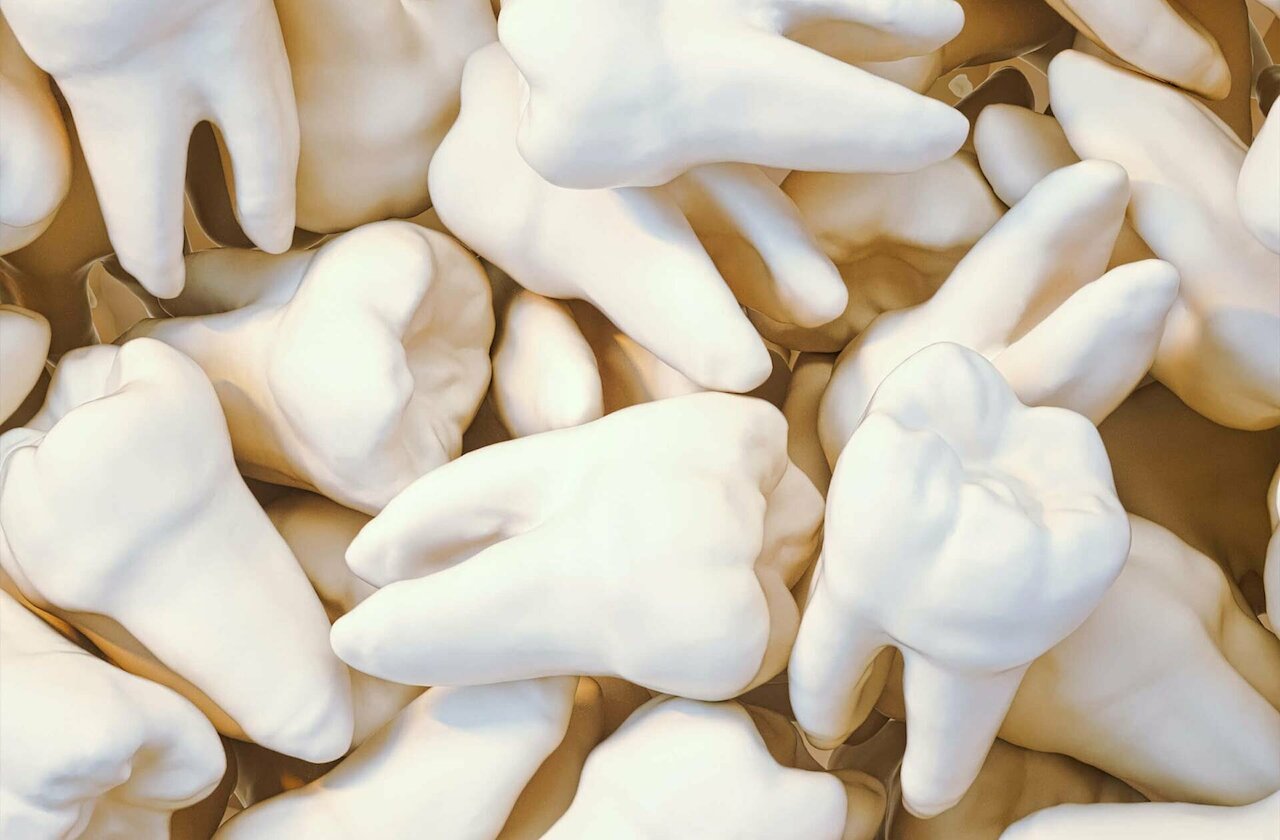 Weisheitszähne ziehen: Ist das wirklich nötig?  Image 1