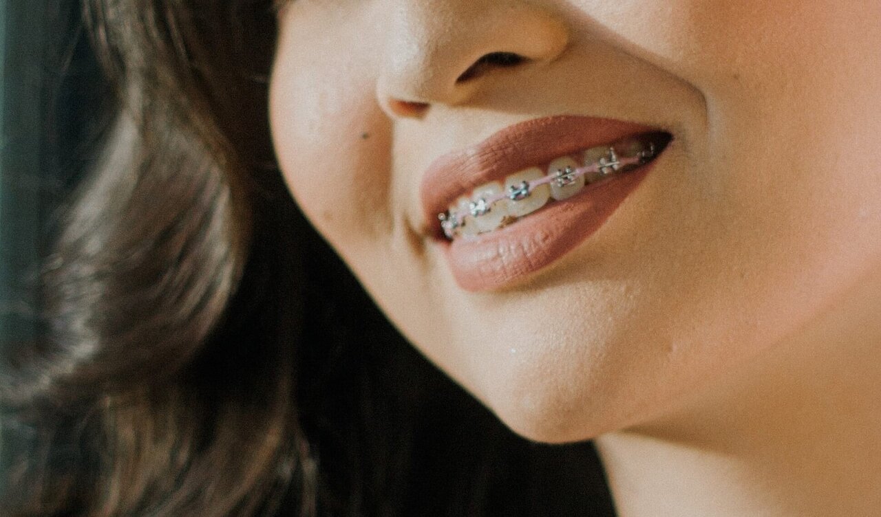 Stört die Zahnspange beim Sprechen? Image 1