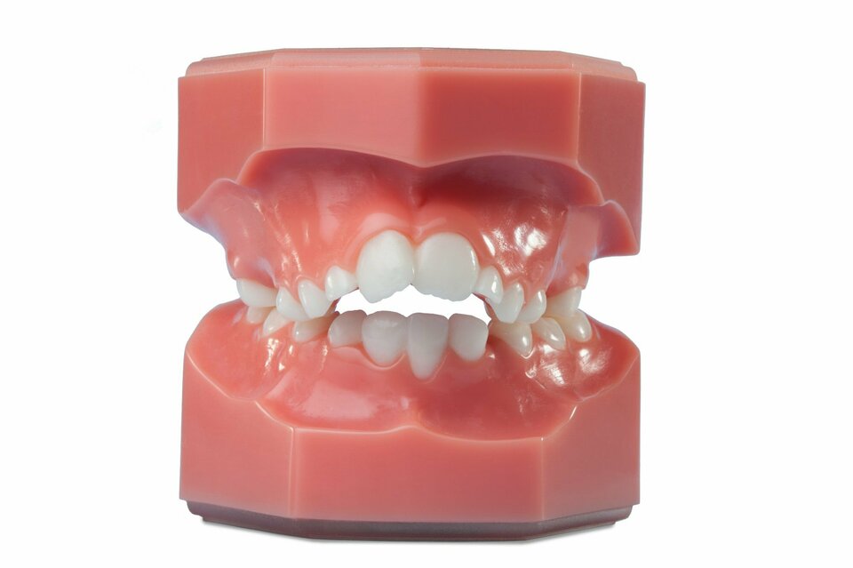 Große Frontzahnstufe frontal