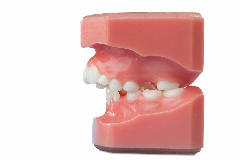 Große Frontzahnstufe profil