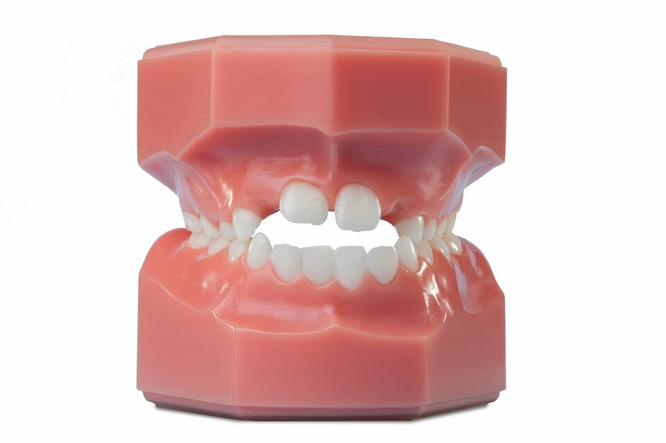 Offener Biss frontal