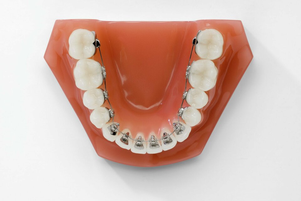 Zahnspange Oberkiefer